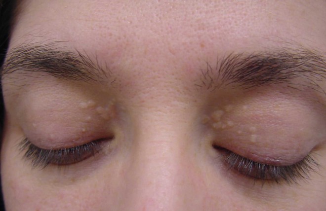 Những u vàng quanh mắt không chỉ làm bạn xấu mà còn cảnh báo nhiều nguy cơ bệnh - làm sao để loại bỏ chúng? - Ảnh 4.