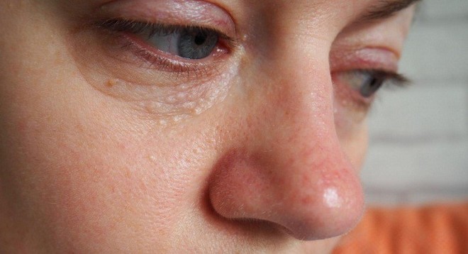 Những u vàng quanh mắt không chỉ làm bạn xấu mà còn cảnh báo nhiều nguy cơ bệnh - làm sao để loại bỏ chúng? - Ảnh 3.