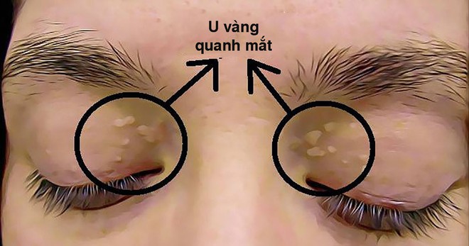 Những u vàng quanh mắt không chỉ làm bạn xấu mà còn cảnh báo nhiều nguy cơ bệnh - làm sao để loại bỏ chúng? - Ảnh 2.