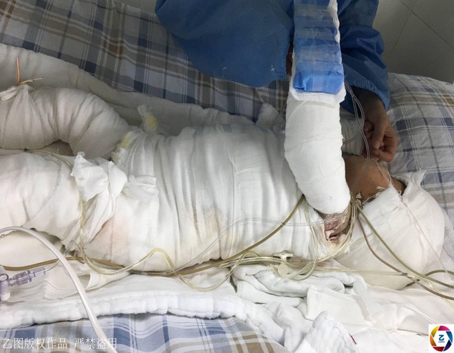 Trung Quốc: Hoàn cảnh thương tâm của bé trai 17 tháng tuổi bị bỏng toàn thân do một phút bất cẩn của bà - Ảnh 1.