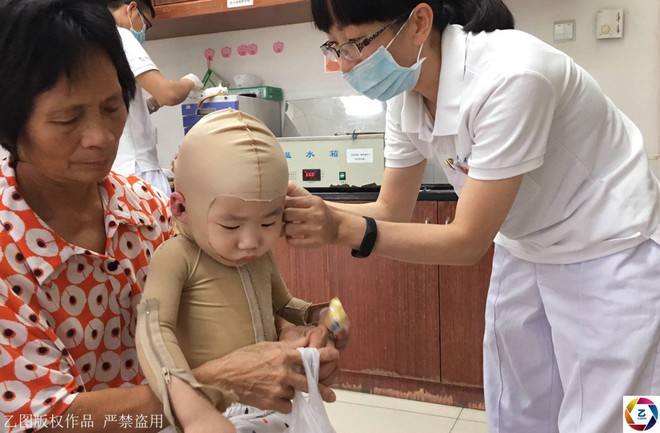 Trung Quốc: Hoàn cảnh thương tâm của bé trai 17 tháng tuổi bị bỏng toàn thân do một phút bất cẩn của bà - Ảnh 2.