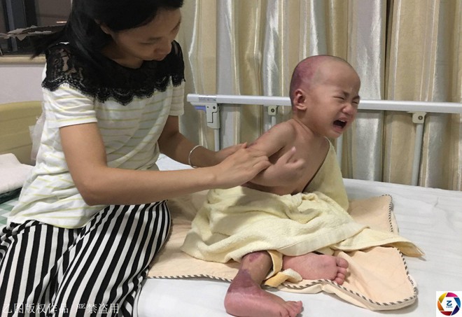 Trung Quốc: Hoàn cảnh thương tâm của bé trai 17 tháng tuổi bị bỏng toàn thân do một phút bất cẩn của bà - Ảnh 3.