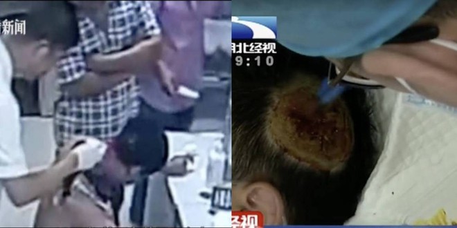 Trung Quốc: Đặt pin dự phòng dưới gối khi ngủ, pin bất ngờ phát nổ khiến người đàn ông bị cháy đen thui một mảng đầu - Ảnh 1.