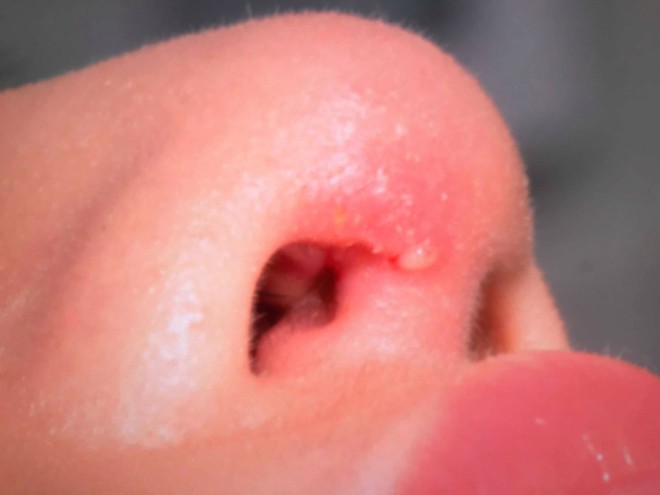 Nâng mũi bằng sụn nhân tạo, cô gái xinh đẹp bị nhiễm trùng 3 lần đến mức mưng mủ, chảy máu trong - Ảnh 7.