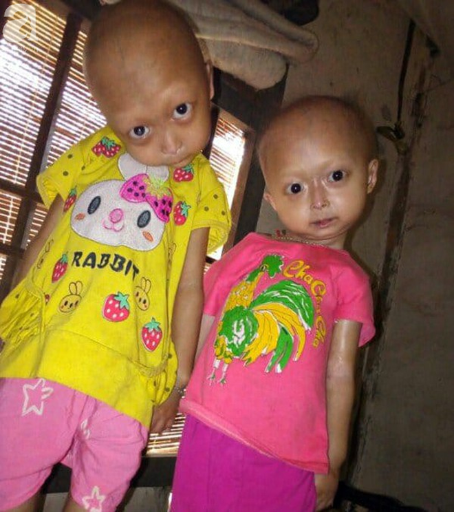 Tuyên Quang: 2 chị em gái mắc bệnh lạ khiến đầu, cổ bị nghẹo tựa người ngoài hành tinh khiến ai nhìn cũng xót xa - Ảnh 2.