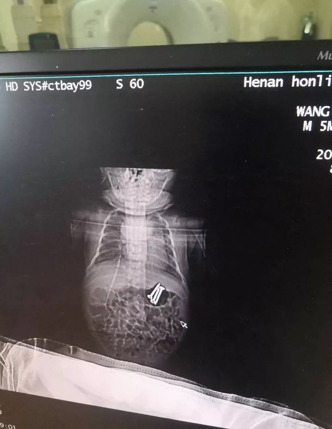 Bà mẹ vô tư nhất trần đời: Để con nhỏ 3 tuổi trông em mới 37 ngày tuổi, trong phút chốc đã thấy con sùi bọt mép vì thứ kinh khủng này - Ảnh 2.