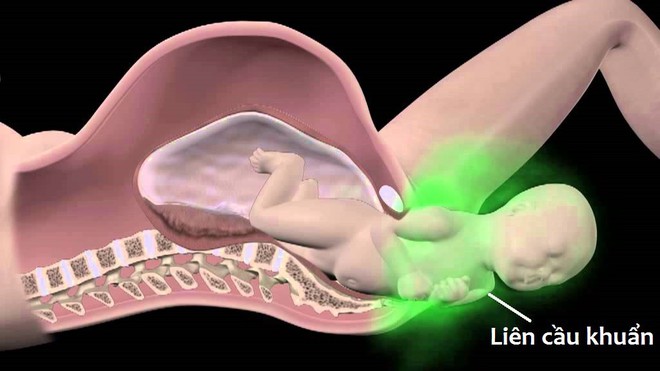 Căn bệnh này có thể lây nhiễm từ mẹ sang con trong quá trình sinh nở khiến trẻ sơ sinh tử vong sau khi chào đời - Ảnh 4.