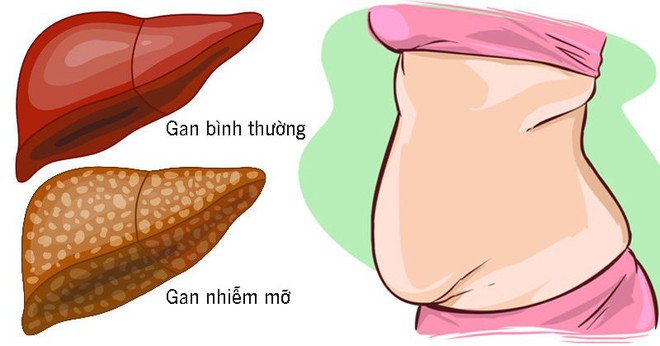 10 dấu hiệu cho thấy gan đang phải làm việc quá tải và chứa đầy độc tố, dễ phát triển thành gan nhiễm mỡ - Ảnh 2.