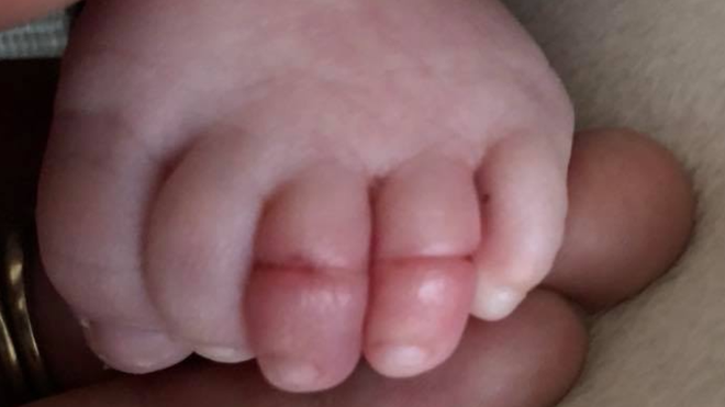 Thêm 1 bé sơ sinh suýt mất 2 ngón chân chỉ vì sợi tóc của mẹ - Ảnh 1.