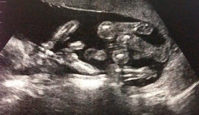 Chưa kịp vui mừng vì sắp được đón 2 con sinh đôi, người phụ nữ rụng rời khi nhận được thông báo từ bác sĩ - Ảnh 4.