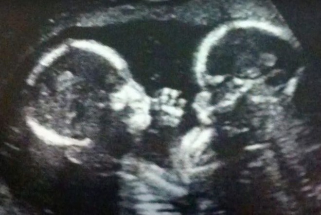 Chưa kịp vui mừng vì sắp được đón 2 con sinh đôi, người phụ nữ rụng rời khi nhận được thông báo từ bác sĩ - Ảnh 5.