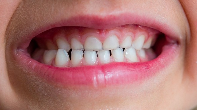 Nếu vẫn tự tin con đánh răng đủ 3 lần mỗi ngày sẽ không bị sâu răng thì cha mẹ hãy xem lại - Ảnh 3.