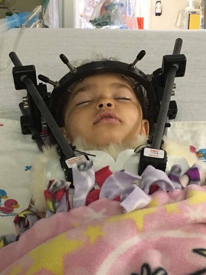 Bé gái bị tổn thương cột sống, tê liệt chỉ vì sai lầm của mẹ khi đặt con vào ghế ngồi ô tô - Ảnh 1.