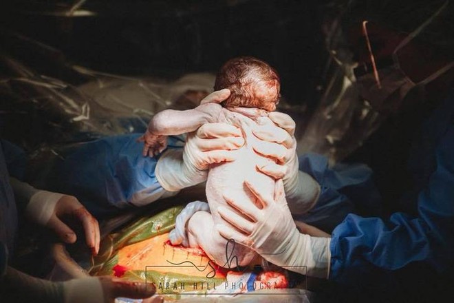 Nín thở xem khoảnh khắc nữ y tá tự tay nhấc con ra khỏi bụng mẹ trong ca sinh mổ của chính mình - Ảnh 6.