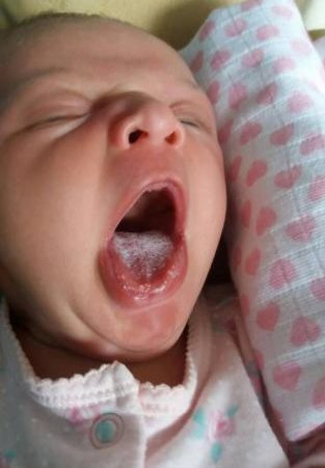 Những hiện tượng thường gặp ở trẻ sơ sinh sẽ ảnh hưởng đến sức khỏe của trẻ nếu bố mẹ lơ là - Ảnh 3.