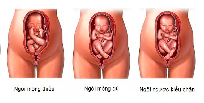 Những điều mẹ bầu cần biết khi được chẩn đoán có ngôi thai ngược   - Ảnh 1.