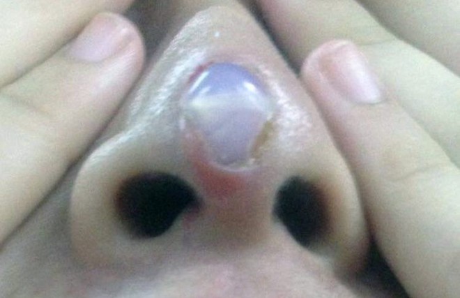 Thêm một cô gái đi phẫu thuật nâng mũi nhưng tham rẻ nên nhận hậu quả đau đớn, rách mũi để lộ cả silicon - Ảnh 1.