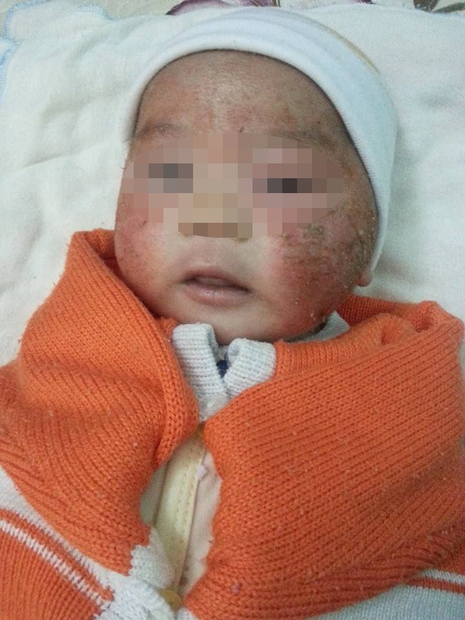 Xót xa em bé 3 tháng tuổi viêm da bội nhiễm, loét hết mặt vì tắm lá - Ảnh 4.