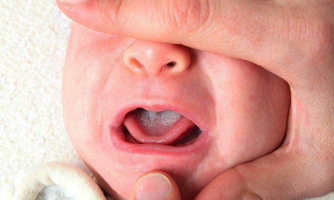 Cứ đến giờ ăn là trẻ quấy khóc bỏ bú là vì bé đã nhiễm một loại ký sinh khó chịu hay tái phát này - Ảnh 5.