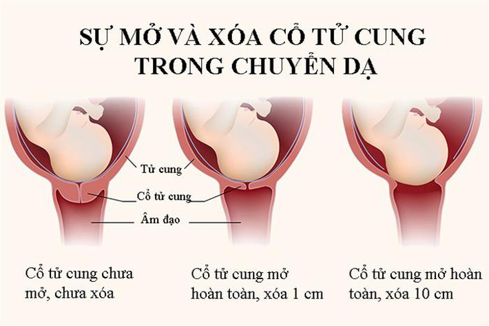 Những điều cơ bản mẹ bầu cần biết về khám cổ tử cung khi chuyển dạ - Ảnh 1.