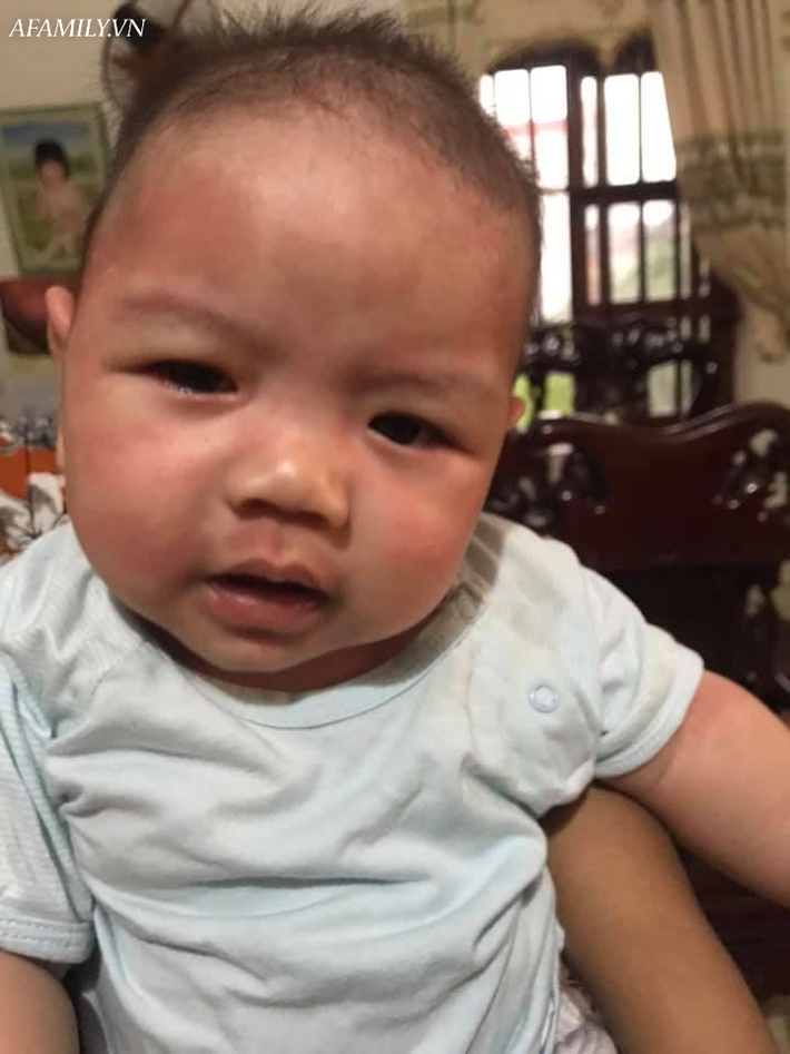 Bé 4,5 tháng tuổi bị sốc phản vệ, người lịm đi, chân tay không phản ứng sau khi được tắm bằng mướp đắng - Ảnh 1.