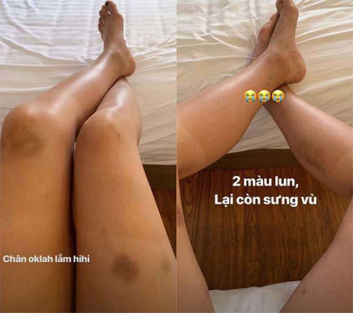 Ai lười bôi kem chống nắng sẽ tởn đến già khi xem những hình ảnh cho thấy tia UV có thể hủy hoại làn da kinh hoàng thế nào - Ảnh 2. Ai lười bôi kem chống nắng sẽ tởn đến già khi xem những hình ảnh cho thấy tia UV có thể hủy hoại làn da kinh hoàng thế nào - Ảnh 2.