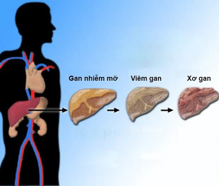 Hai căn bệnh cực kỳ phổ biến nhưng rất dễ phát triển thành ung thư, bạn cần ngăn chặn ngay từ bây giờ  - Ảnh 2.