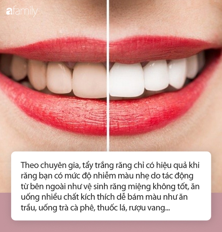 Sử dụng hydrogen peroxide để làm trắng răng: Chuyên gia khuyến cáo cần hết sức cẩn trọng! - Ảnh 3.