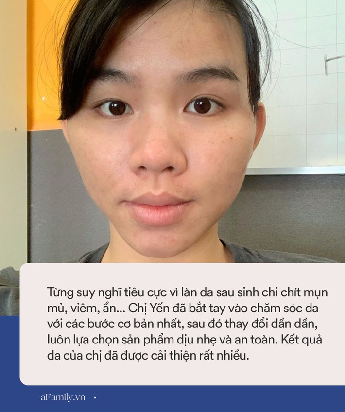 Từng sợ chồng không dám lại gần vì làn da chi chít mụn sau sinh, nhưng tất cả đã được mẹ 9x giải quyết trong 