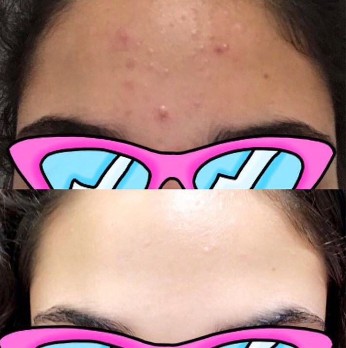 acne-before-after-1534182777 acne-before-after-1534182777