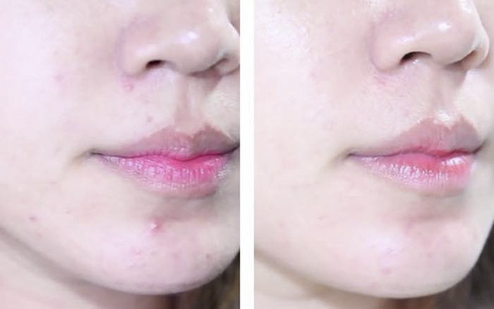 Nuoc-Hoa-Hong-Tri-Mun-Dokudami-Natural-Skin-7 Nuoc-Hoa-Hong-Tri-Mun-Dokudami-Natural-Skin-7