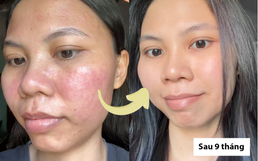 Hành trình dưỡng khí huyết "cứu" da hư tổn của cô nàng tuổi 30: Từng “toang” vì peel da, giờ da dẻ hồng hào, căng mịn, khỏe từ bên trong