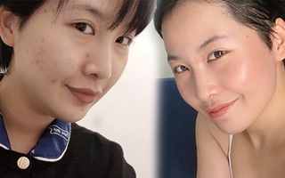 Mất 6 tháng trị mụn viêm và có lại làn da bóng khỏe, mẹ bỉm sữa nghiệm ra: Đồ skincare rẻ đôi khi được việc hơn đồ hi-end
