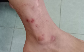 Biến chứng da do tùy tiện dùng Corticoid bôi ngoài da