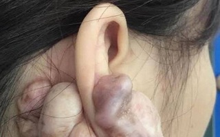 Hình ảnh sẹo đùn kín tai "do nâng mũi bằng sụn tai" gây sốc trên MXH: Có hay không việc sửa mũi đẹp xong khiến tai bị dị dạng?