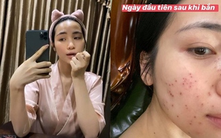 Hòa Minzy gây sốc khi để lộ gương mặt toàn nốt đỏ li ti, nhìn qua đã thấy rùng mình