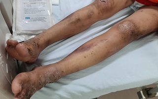 Nữ nhân viên bị chủ quán cà phê tra tấn, chích điện, ép kích dục cho khách đã xuất viện