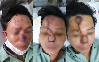 Tái tạo mũi cho bệnh nhân ung thư bị xâm lấn đường thở