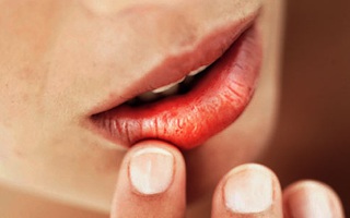 Môi khô, bong tróc có thể là hậu quả từ những thói quen này, thói quen thứ 3 là nhiều người mắc nhất
