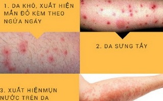 Điểm mặt bệnh về da thường gặp vào mùa hè