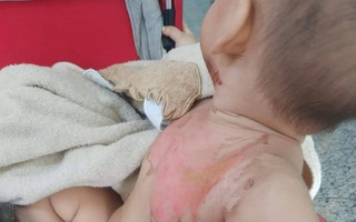 Bé 2 tuổi bị bỏng nước sôi pha mì tôm khi đùa cùng anh trai