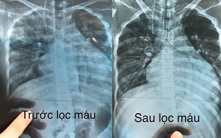 Bệnh viện Nội tiết Nghệ An cứu sống bệnh nhân đái tháo đường có biến chứng nặng