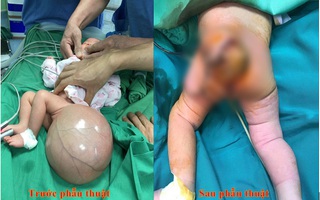 Phẫu thuật thành công cho trẻ sơ sinh bị bệnh thoát vị màng não tủy hiếm gặp 