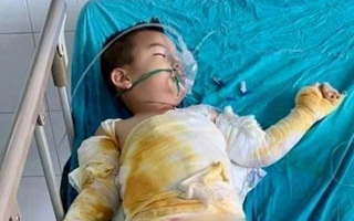 Vụ cháy phòng ngủ lúc nửa đêm, cả gia đình bỏng nặng: Người chồng đã tử vong, vợ và 2 con thơ nguy kịch
