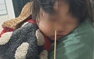 Đang ăn kem thì vấp ngã, bé gái 2 tuổi bị que kem dài 20cm chọc xuyên hốc mắt