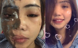 Vụ cô gái bị chồng sắp cưới tạt axit biến dạng gương mặt: Sau một năm đã trở lại với nụ cười xinh đẹp rạng rỡ