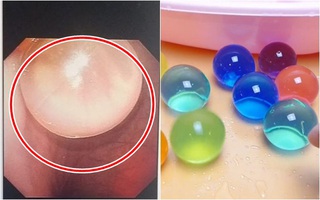 Lời cảnh báo tới cha mẹ về thứ đồ chơi được nhà sản xuất ghi là an toàn, không độc hại nhưng khiến bé trai ăn gì nôn nấy, suýt tắc ruột
