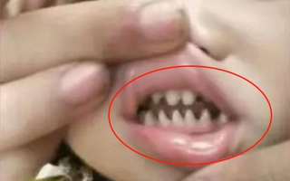 Con có hàm răng như "răng cá mập", bà mẹ hối hận vì nguyên nhân là do mình
