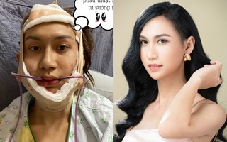 Lynk Lee khoe cận cảnh gương mặt biến chuyển qua từng giai đoạn hậu chuyển giới, nhìn lúc mới phẫu thuật xong mà xót xa