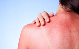 Chuyên gia da liễu giải thích ngộ độc nắng là gì, triệu chứng, cách khắc phục và ngăn ngừa